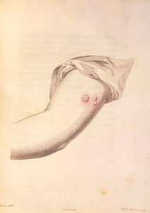 William Pead karja himlőoltásra használt Edward Jenner (1748-1823) „A Variolae Vaccinae okainak és következményeinek vizsgálata” című művéből, Pearce metszete, 1800 körül